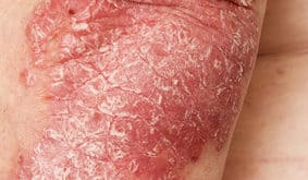 Reishi gegen Psoriasis