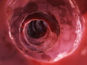 Morbus Crohn