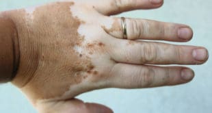Vitiligo auf der Hand