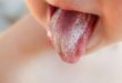 Candida Belag auf Zunge