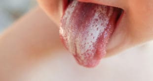 Candida Belag auf Zunge