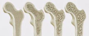 Osteoporose 4 Stadien