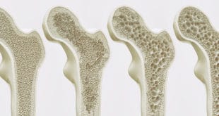 Osteoporose 4 Stadien